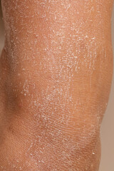 Leg of woman with dry and dehydrated skin