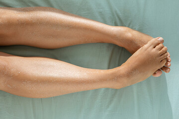 Women's legs with dry skin