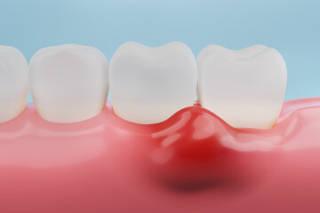 Gums inflammation, gingival recession. Dental treatment concept. 3D rendering. - obrazy, fototapety, plakaty