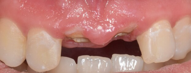Dentistry clinic case of a patient with oral disease located in the central incisor because of...