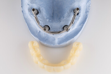 a model with a bar and a temporary prosthesis for immediate loading after implantation, top view on a white background