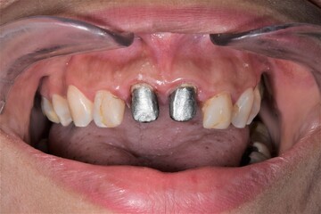 Two metallic post and core reconstructions cemented in the central incisal tooth. Front view of...