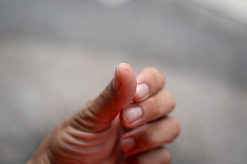 Knife cut mark on the human hand thumb finger. Healthcare and accident abstract photo, selective...