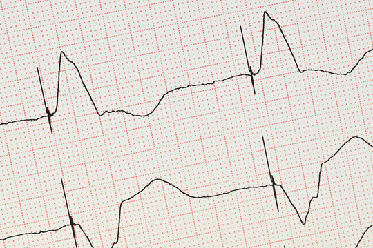 Elektrokardiogramm mit Schrittmacheraktionen