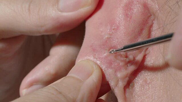 Acne treatment footage. Squeezing blackhead pimple with stainless steel medical acne remover tool. Pressing and removing blackhead pimple from earlobe skin. Acne skin problem closeup skincare concept.