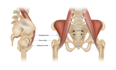 Internal snapping hip Syndrome. Psoas major, Iliopsoas muscle and Snapping area. Vector - obrazy, fototapety, plakaty