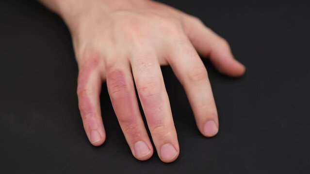 Man's hand with burns, blisters on his fingers. Unrecognizable male showing dangerous injury.