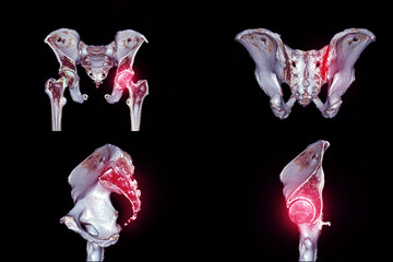 Collection of traumatic case CT scan of  pelvic bone.