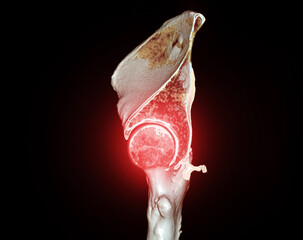 CT scan of Pelvic bone and hip joint 3D rendering for diagnosis fracture of Pelvic bone and hip...