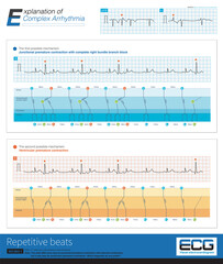 Ventricular and junctional premature contractions can activate the ventricle again through the reentry mechanism to form the complex arrhythmia of repetitive beats.