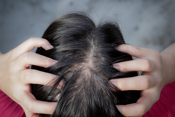 Fototapeta premium young woman with thin hair problem, top view of scalp spot baldness make people lack of confidence, a girl worry about hair fall problem