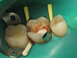 treatment of a tooth with a hole at the dentist. a decayed tooth from the inside in a person's mouth. a procedure for treating a neglected tooth