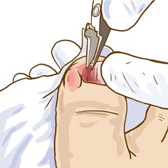 cartoon treatment of ingrown toenails