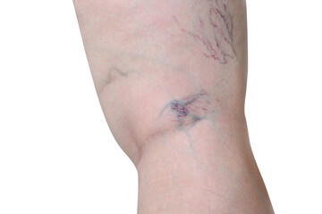 Woman exposing leg with varicose veins on leg capillary varicose veins show isolated on a white background