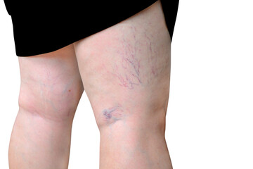Woman exposing leg with varicose veins on leg capillary varicose veins show isolated on a white background - obrazy, fototapety, plakaty