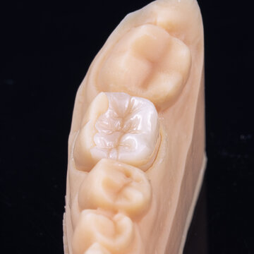 Composite onlay on 3d printed model