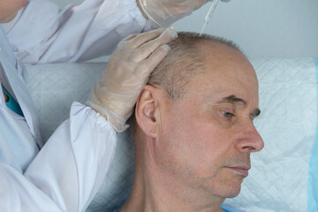 Obraz premium close-up trichologist treats patient, bald mature man with alopecia in hair growth clinic, anti-aging treatments for balding men. concept of hair transplant procedures for men, selective focus