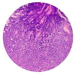 Supraclavicular lymph node biopsy: Microscopic image showing benign follicular hyperplasia. Reactive hyperplasia. Reactive change.