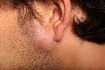 Obraz premium Lipoma on the face