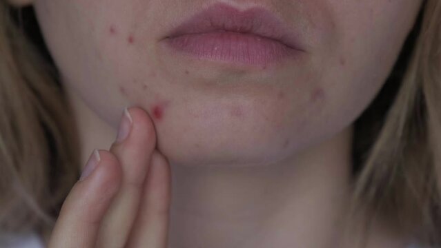 Unrecognizable woman showing her acne on face. Close-up acne on woman's face with rash skin ,scar and spot that allergic to cosmetics. Problem skincare and health concept. Wrinkles, melasma, dark