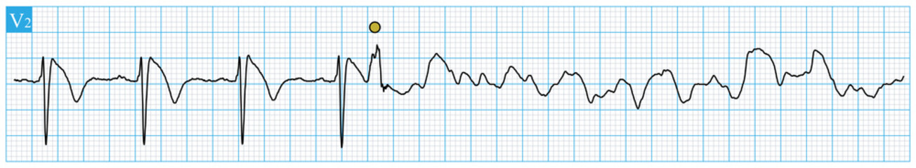 One patient with primary Brugada syndrome, whose ECG showed type 1 Brugada pattern, subsequently developed ventricular fibrillation, and survived after timely defibrillation treatment.