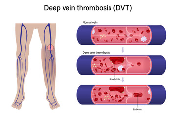 Diagram of the legs with enlarged images of normal veins and deep vein thrombosis. Vectors for use in scientific and medical studies.