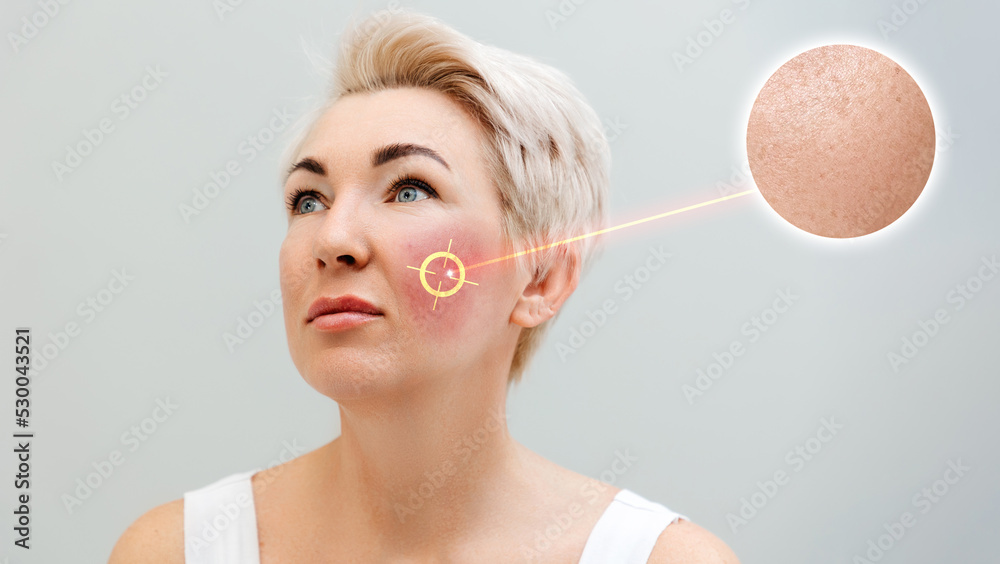 Wall mural portrait of an adult caucasian blonde woman with redness on her cheeks. laser removes couperose show