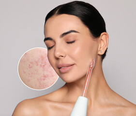 Young woman using darsonval on light grey background