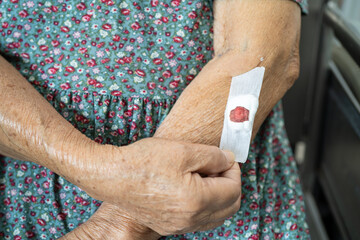 Asian senior or elderly old lady woman patient show cotton wool stop bleeding, after blood drawing testing for annually physical health check up to check cholesterol, blood pressure, and sugar level.