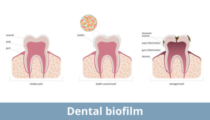 Dental biofilm. Biofilm covers teeth and causes enamel desolvation, inflammation of a gum and pulp. Biofilm on a tooth damages dental tissues, provokes abscess formation.