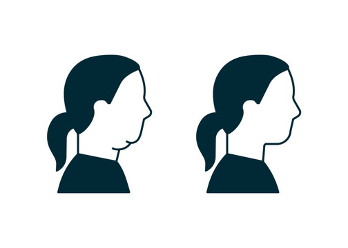 Double chin of woman icon, change in facial aesthetics. Fat loss in overweight on face. Profile girl before and after liposuction, lifting, plastic procedure. Vector illustration