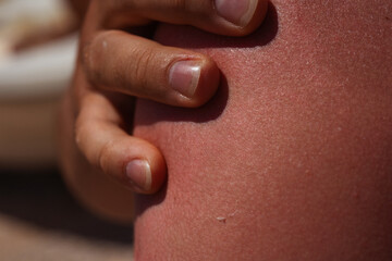 sunburn on the skin of a man. swollen skin from blisters on the boy's shoulder. red skin he has an overabundance of sun. sunburn at a dangerous hour - obrazy, fototapety, plakaty