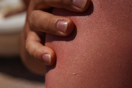 sunburn on the skin of a man. swollen skin from blisters on the boy's shoulder. red skin he has an overabundance of sun. sunburn at a dangerous hour