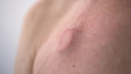 An elderly man has a catheter under the skin for chemotherapy. Close-up of a catheter on a man's...