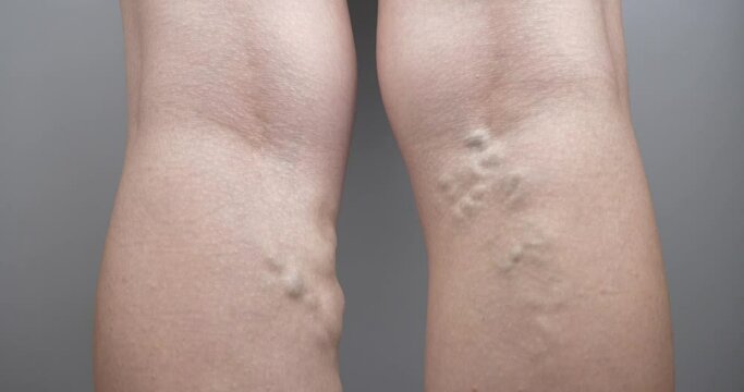 female varicose legs, swollen veins. High quality 4k footage