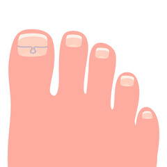 Toes on the right foot with a titanium staple on the thumb for correction of the shape of the toenail cartoon vector illustration isolated on a white background - obrazy, fototapety, plakaty