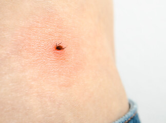 Tick on waist of woman after walk forest. Castor bean tick attached to skin and started to draw...