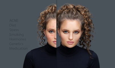 Post-Acne Marks Treating Acne Scars.Acne Scar Removal