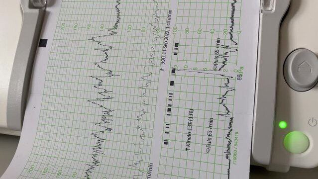 Close up shot of Cardiotocograph printing heartbeat and contractions of baby in hospital