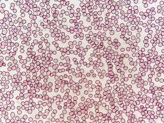 Microscopic view of hematological stained slide. thrombocytopenia. Extremely low level of platelet...