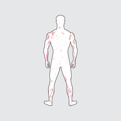 Painful dermatous rash on body with white skin