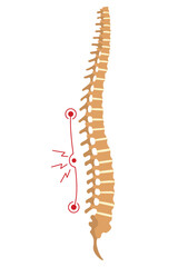 Spinal deformity. Symbol of spine curvatures or unhealthy backbones. Human spine anatomy, curved spine. Diagram with marked section. Body posture defect