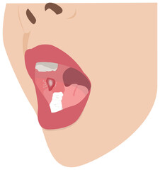stomatitis in mouth