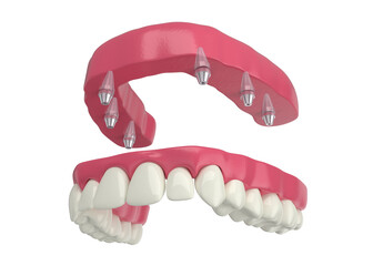 dental prosthesis, 6 overdenture implants, upper arch, 3d render
