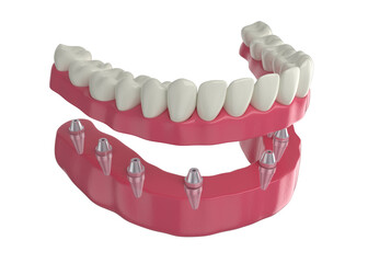 dental prosthesis, 8 overdenture implants, lower arch, 3d render