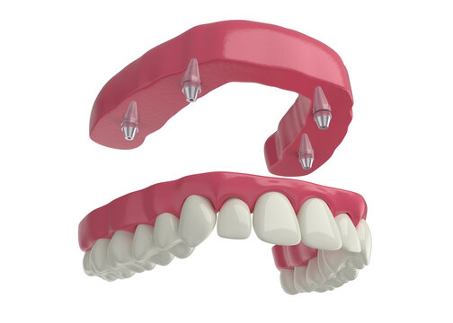 dental prosthesis, 4 overdenture implants, upper arch, 3d render

