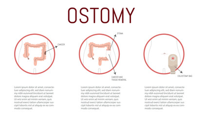 Ostomy process in case of cancer, once detected, it is sectioned and the bag is placed.