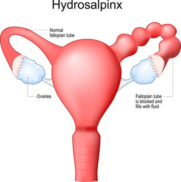 Hydrosalpinx. Human uterus with blocked of Fallopian tube.