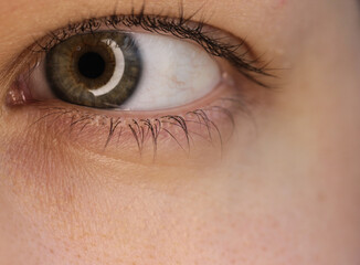 Hazel is the eye of a middle-aged Slavic woman.A black floating spot in the eye as a symptom of diabetes. Retinopathy.