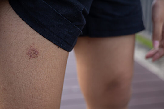 Fungal lesions on the legs, portraits, skin care care images.